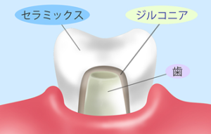 ジルコニア｜すわ歯科医院