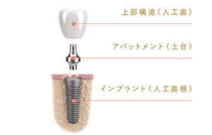 インプラント治療｜すわ歯科医院