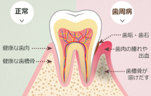 歯周病治療｜すわ歯科医院